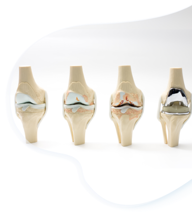 image of 4 types of knee joints