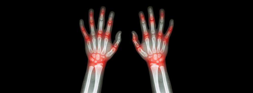 Managing Arthritis: Empowering Yourself Beyond Disability with Dr. Mitchell McDowell at M Bone and Joint