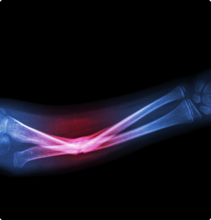 x-ray image of arm fracture