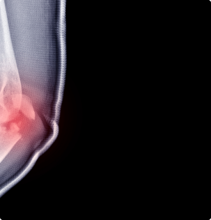 x-ray image of elbow fracture