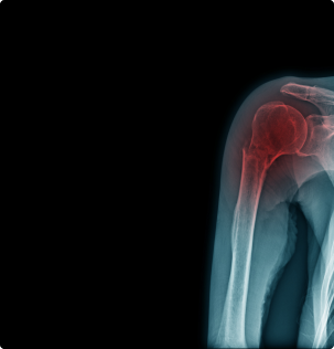 x-ray image of shoulder fracture