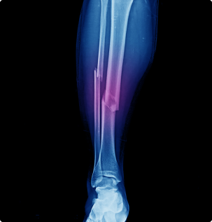 x-ray image of leg fracture