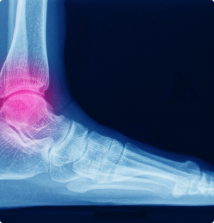 x-ray image of ankle fracture