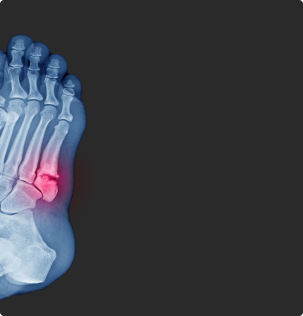 x-ray image of foot fracture